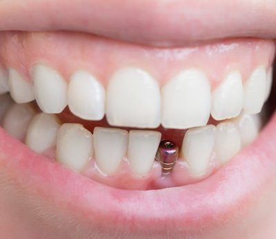 Close up of patient’s dental implant