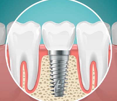 Digital image of a dental implant anchored to the jawbone
