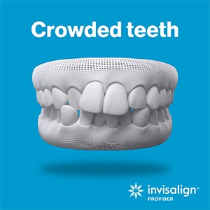 dental hygienist holding two clear aligners in the shape of a heart