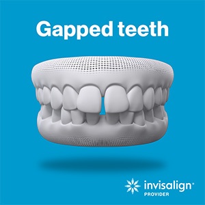 dental hygienist holding two clear aligners in the shape of a heart