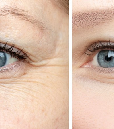 Before and after of a BOTOX treatment for crow’s feet