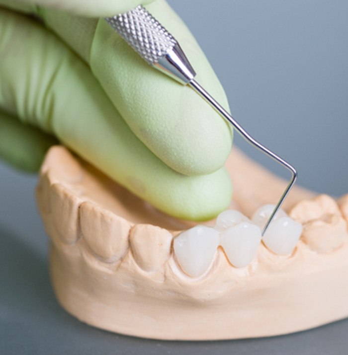 a model of a dental bridge