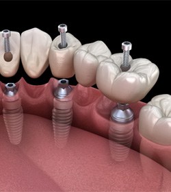 a digital illustration depicting an implant bridge