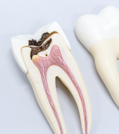 Model of a decayed tooth in need of a root canal in Dayton, OH