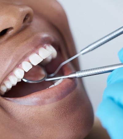 Gloved hands using mirror and probe to examine patient’s teeth