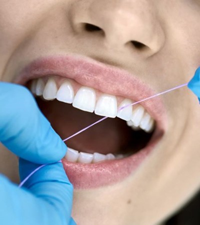 Gloved hands using floss to clean between patient’s teeth