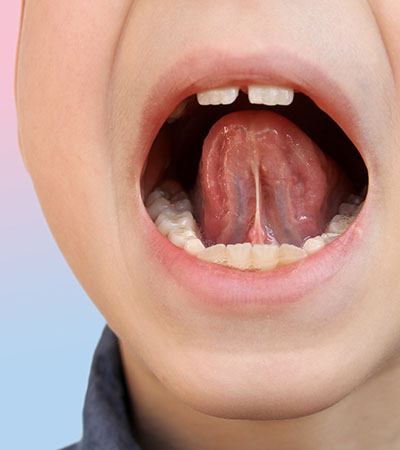 Child's mouth after fenectomy