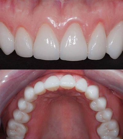 Closeup of smile after porcelain veneer treatment