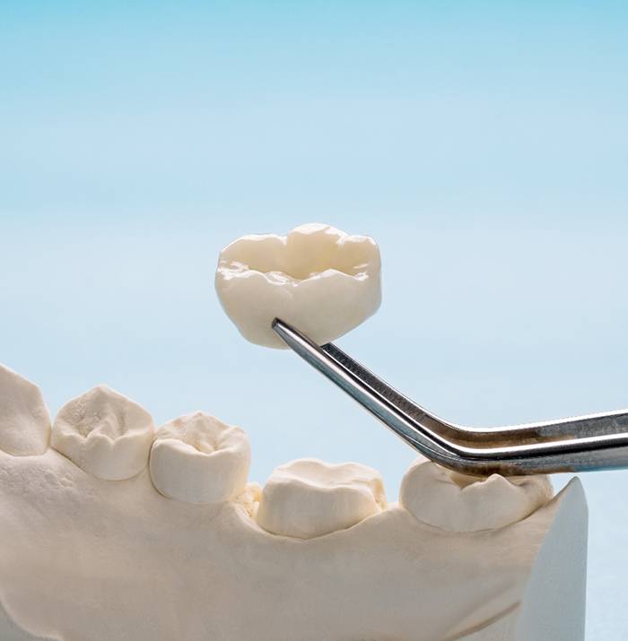 A closeup of dental crowns in Dayton