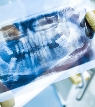 Gloved hands holding dental X-ray