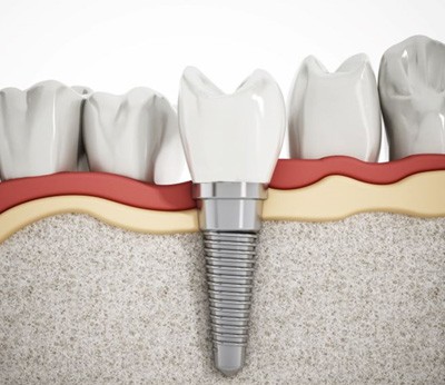 Illustration of single dental implant next to natural teeth