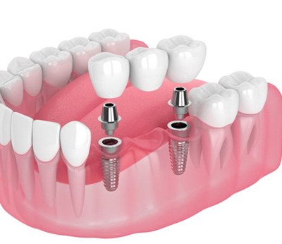 Illustration of three-unit dental implant bridge