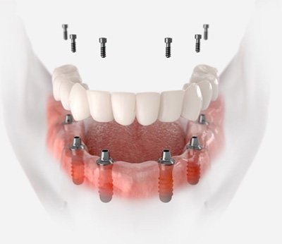 Illustration of fixed implant denture for lower arch