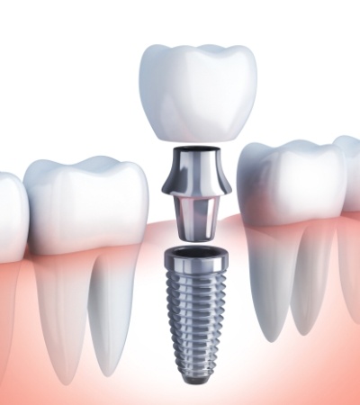 Animated dental implant supported replacement tooth