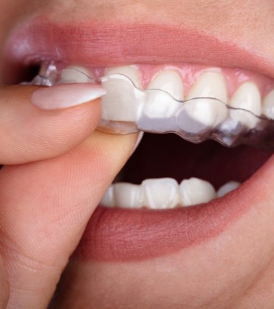 close-up of a person putting an Invisalign tray in their mouth 