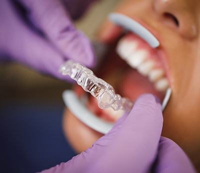 patient getting Invisalign in Sugarcreek Township