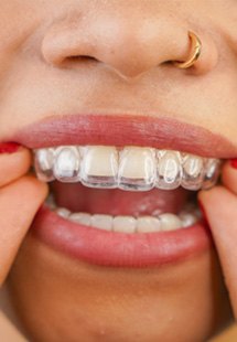 Woman putting in clear aligners