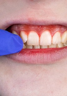 Closeup of bleeding gums