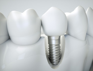 Close-up of a model of a single dental implant
